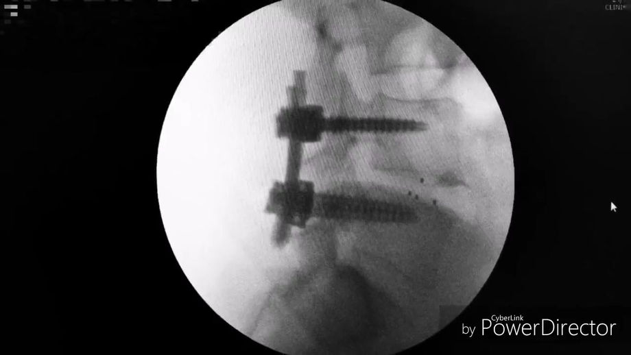 MIS TLIF con tornillos percutaneos